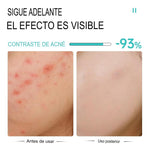 (2X1) Crema Anti Acné "Bioaqua" Promoción Especial⌛