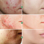 (2X1) Crema Anti Acné "Bioaqua" Promoción Especial⌛