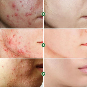(2X1) Crema Anti Acné "Bioaqua" Promoción Especial⌛